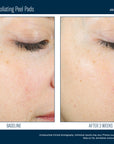 AlphaRet Exfoliating Peel Pads